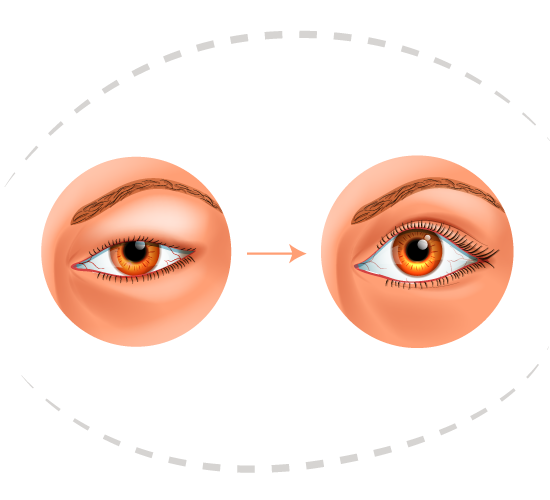 Chirurgie esthétique des yeux et du regard