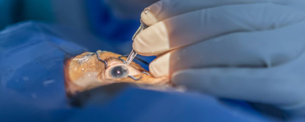 La chirurgie réfractive